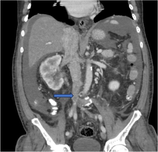 CT chest abdomen and pelvis with contrast showing inferior extension to the level of the distal margin of the IVC.
