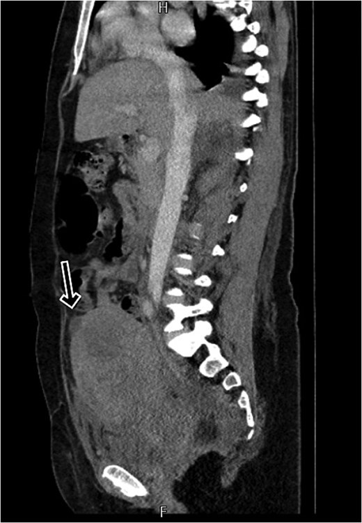CT scan shows a linear small defect in the anterior wall of uterine fundus with small collection (2 × 1 cm).