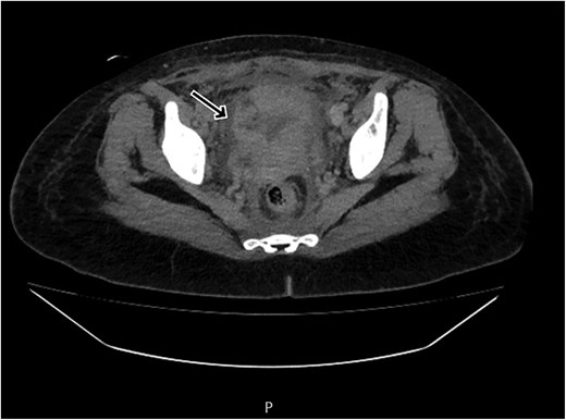 CT scan revealing a ruptured uterine scar with omental herniation.