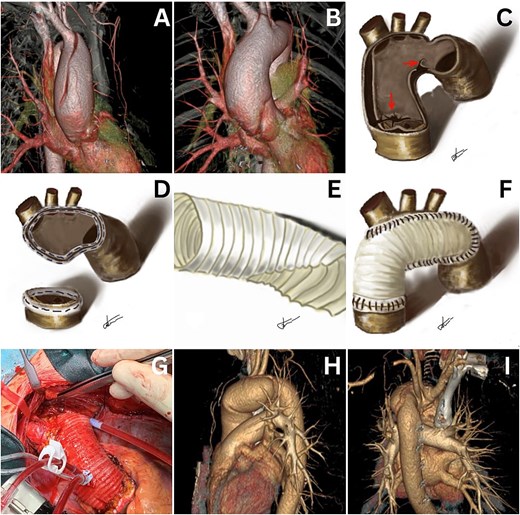 Computed tomography reveals a type A acute aortic dissection (A and B). Freehand drawings illustrate marked entry and reentry points (C), aortotomy sites for anastomoses (D), and tailoring of the Dacron graft (E and F). The final intraoperative treatment result is shown (G). Computed tomography images demonstrate good treatment results at the 18-month follow-up in the outpatient clinic (H and I).