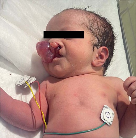 Clinical appearance of preoperatively large oropharyngeal swelling associated with a cleft palate.
