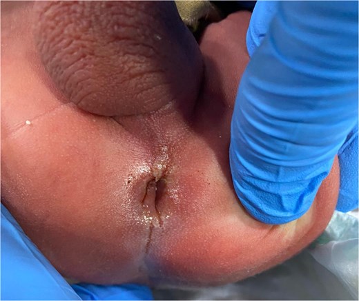 Clinical appearance of imperforate anus.