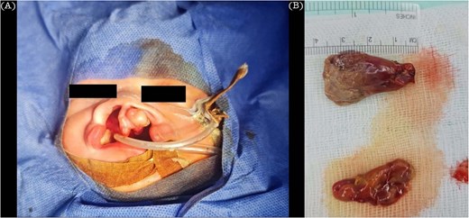 (A) Clinical appearance of pateint teratoma removal. (B) Two soft mass after removal the biggest measuring 2.3 × 1.5 × 1.2 cm in greatest dimensions.
