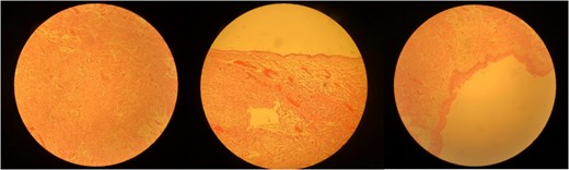 The cyst is lined by squamous epithelial cells without atypia. In the wall there are variable amount of different elements including upper respiratory type mucus secreting epithelium, glial tissue and small focus of granulomatous reaction.