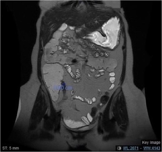 MRE of the abdomen showing a coronal view of the short segment fibrosis at the terminal ileum with mild dilated small bowel loops.