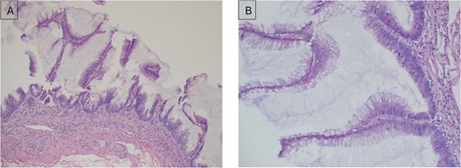 (A) Low-grade appendiceal mucinous neoplasm (LAMN) of the appendix; (B) higher magnification (× 20) of LAMN of the appendix.