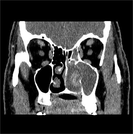 Coronal section of CT paranasal sinus with contrast soft tissue window showing the mass occupying the left nasal cavity and extending to maxillary and ethmoidal sinus.