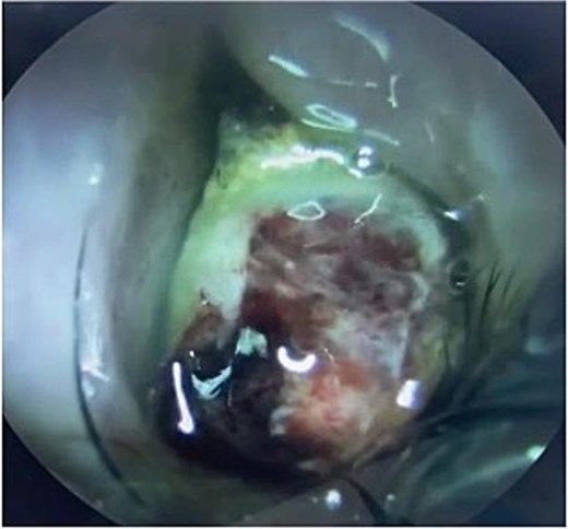 Yellowish greenish nasal mass occupying the left nasal cavity with blood stain.