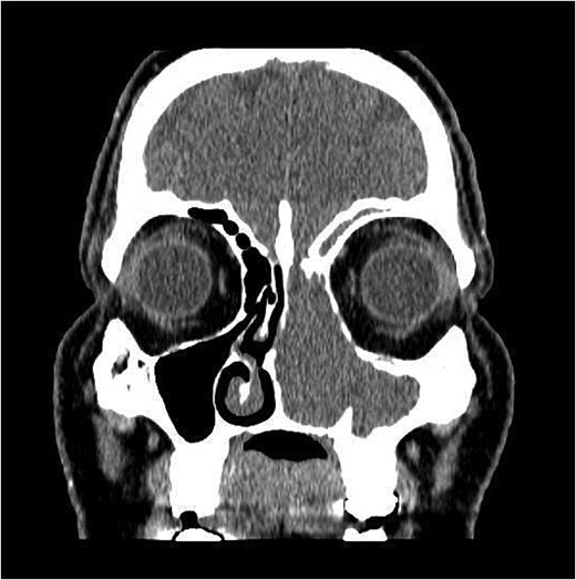 Coronal section of CT paranasal sinus soft tissue window showing the mass occupying the left nasal cavity and extending to maxillary and ethmoidal sinus, and reaching base of skull.