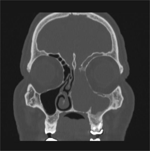 Coronal section of CT paranasal sinus bone window showing bony erosions of nasal septum, maxillary wall, lamina papyracea, and cribriform plate.