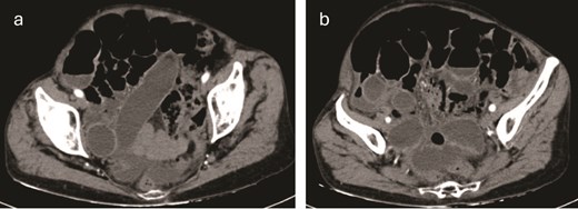 (a, b) Contrast-enhanced CT of the abdomen revealed loops of small intestine with dilation up to 31 mm and the presence of a whirl sign at the level of the distal ileum associated with a transition zone.
