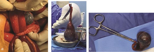 (a) Appendiceal tumor at the tip of the appendix causing strangulation of the distal ileum with discoloration changes. (b, c) An appendix measuring 6 × 1.5 cm with a tumor at the tip measuring 10 × 8 cm.