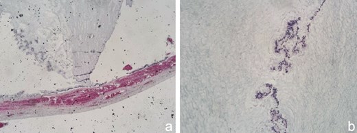 (a) This image shows a longitudinal section of the appendiceal wall. The mucosa is characterized by distension due to the accumulation of mucinous material. The wall appears relatively intact without significant disruption. The mucinous material is stained with hematoxylin and eosin (H&E), indicating the presence of mucin. This is typical of mucoceles, where mucin displaces the normal appendiceal tissue, leading to distension of the organ. (b) This image provides a closer view of the mucosal layer of the appendix, again showing mucinous material. The absence of cellular atypia and the lack of invasive growth into surrounding tissues suggest a benign mucinous neoplasm, possibly a mucocele rather than a mucinous carcinoma. The blue staining likely represents mucin, highlighted with a special stain such as Alcian blue, which is used to identify acid mucopolysaccharides and glycosaminoglycans, typical components of mucin.
