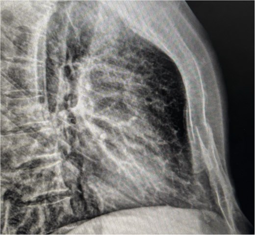 Lateral chest X-ray showing cortical discontinuity in the midportion of the sternal body (red arrow), indicative of an oblique fracture.