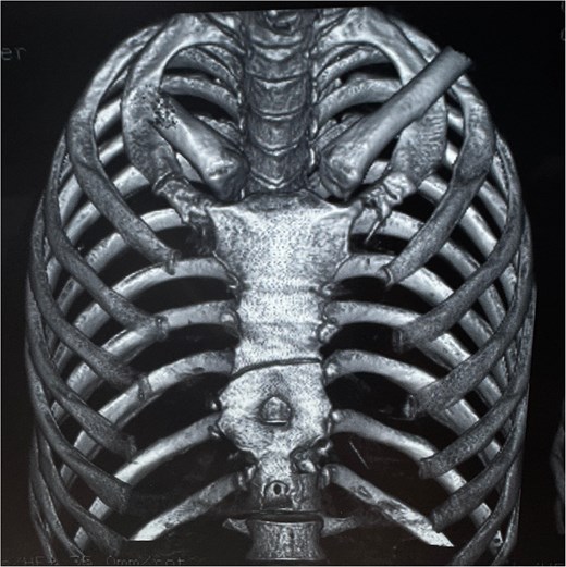 CT (3D reconstruction) revealing a non-displaced sternal fracture and the sternal foramen adjacent to the fracture site.