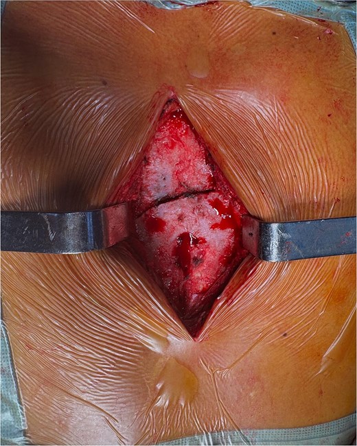 Intraoperative image showing exposure of the sternal fracture before fixation, with the sternal foramen identified in the lower region.