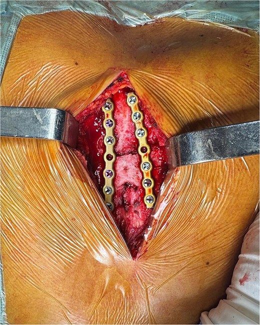Final fixation after placement of two parallel 7-hole plates on the sternal body.