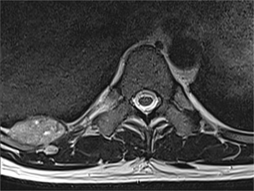 A magnetic resonance imaging scan shows a lesion on the right posterior side of the chest wall.