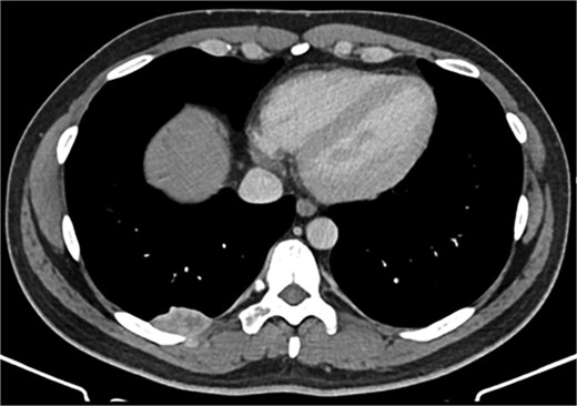 Contrast-enhanced CT scan of the chest.