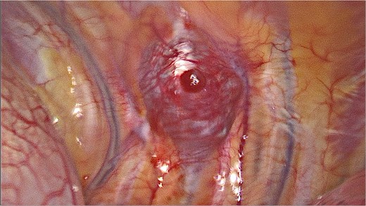 Video-assisted thoracic surgery. Intraoperative view of the tumor.