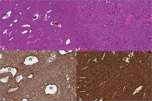 (A) Haemotoxylin & Eosin (H&E) ×100. The tumor consists of branched blood vessels (stars) lined by endothelial cells, surrounded by solid areas of uniform glomus cells. (B) H & E ×200. Glomus cells have a rounded nucleus and an eosinophilic cytoplasm. (C) CD34 ×200. Positive reaction in tumor and endothelial cells lining blood vessels (stars). (D) SMA ×200. Positive reaction in tumor cells.