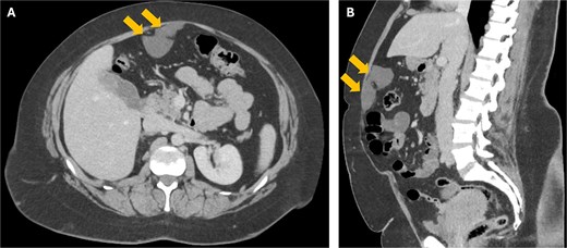 Axial (a) and coronal (b) CT images showing the 8 cm falciform ligament cyst (arrows) just deep to the anterior abdominal wall.
