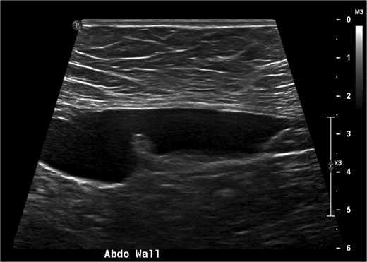 A USS image showing the 8 cm falciform ligament cyst with simple internal contents.