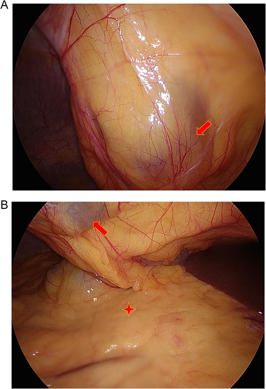 Intraoperative images showing the falciform ligament cyst (arrow) that was above and separate to the omentum (star).