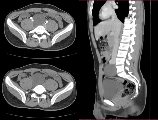 The images provided show axial and sagittal CT views of a well-defined retroperitoneal mass located anterior to the L5 vertebra. The lesion appears encapsulated, homogenous, and slightly hypodense compared to surrounding structures.