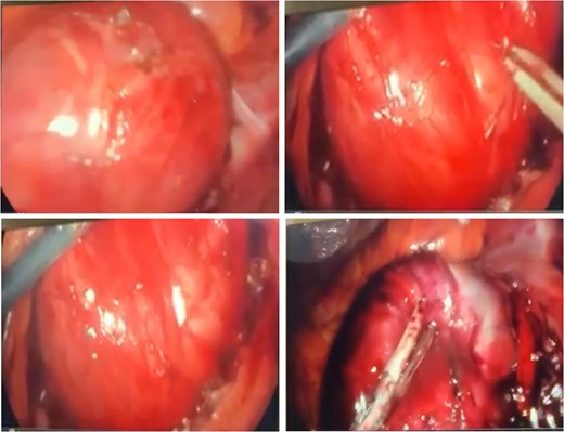 The intraoperative images depict the surgical excision of a large, encapsulated retroperitoneal mass. The mass appears smooth, well-circumscribed, and vascularized, consistent with the gross appearance of a benign tumor. Surgical instruments are shown mobilizing the mass, carefully dissecting it from surrounding tissues without significant invasion into adjacent structures.