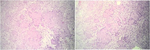 These histological images demonstrate a well-circumscribed tumor with distinct biphasic architecture, characteristic of schwannomas. The hypercellular Antoni A areas, marked by closely packed spindle cells arranged in a palisading pattern, are interspersed with hypocellular Antoni B regions, which exhibit loosely arranged spindle cells within a myxoid stroma. Additionally, degenerative changes, including cystic spaces and evidence of hyalinization, are evident, aligning with the features of an ancient schwannoma. The absence of mitotic figures or necrosis suggests the benign nature of the lesion. This histological presentation, combined with clinical and imaging findings, confirms the diagnosis of an ancient schwannoma.