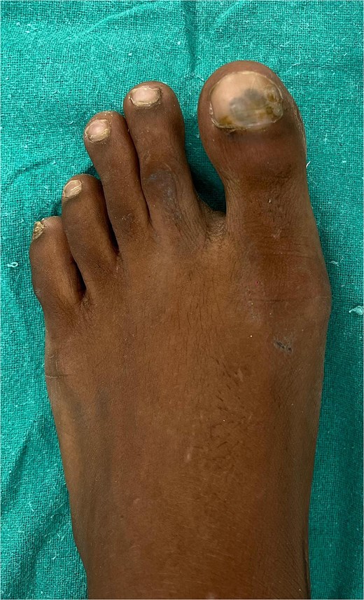 Left great toe presentation with normal skin and nails surrounding the growth.