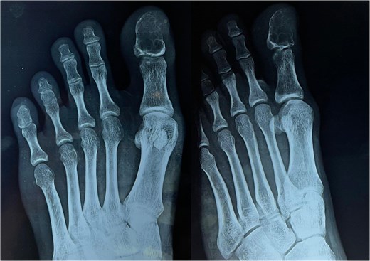 X-ray of the left foot.