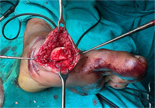 Intraoperative image.