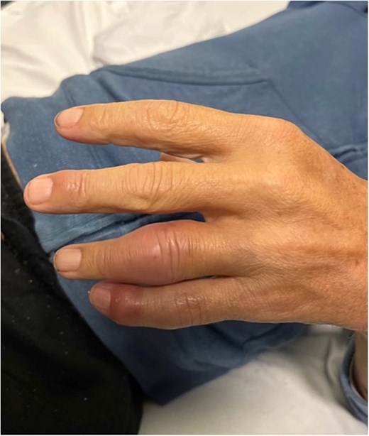 Left fourth and fifth proximal and distal interphalangeal joint.