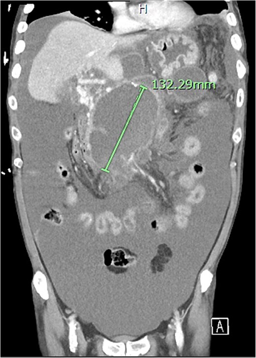 Extensive peripancreatic collections with large volume ascites.