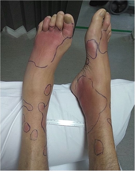 Lower limbs erythematous nodule.