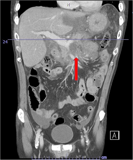 CTAP coronal view; complex peripancreatic fluid collection (arrow) with extension behind the splenic vein to lie adjacent to the pancreatic neck and uncinate process.