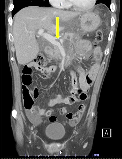 CTAP coronal view; focal thrombus within the portal venous confluence (arrow).