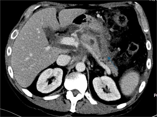 CTAP axial view; acute pancreatitis (arrow).