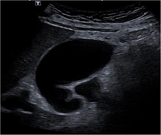 Gallbladder ultrasound.