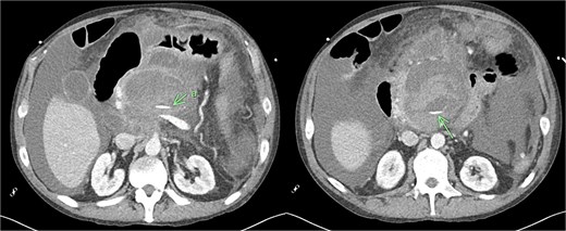CT angiogram of abdomen axial view; contrast extravasation, indicating active bleeding within this peripancreatic collection.