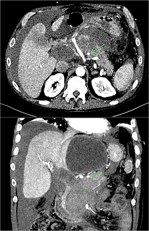 CT angiogram of abdomen axial and coronal view; small pseudoaneurysm arises from a branch of the SMA (arrow). Large haematoma in the head of the pancreas and diffuse haemoperitoneum throughout the abdomen/pelvis.
