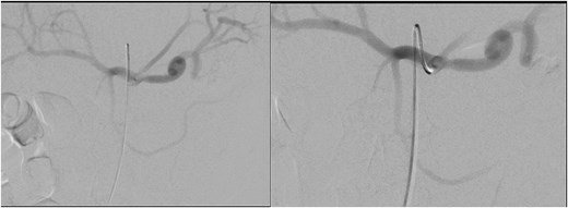 Angioembolization of pseudoaneurysm arising from pancreatic branch off SMA.