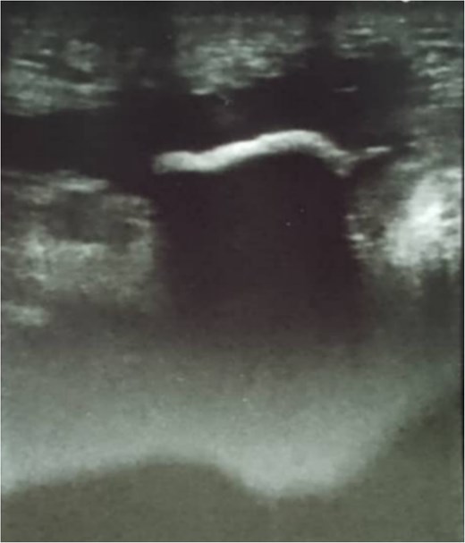 Superficial abdominal ultrasound showing a hyperechoic lesion with posterior acoustic shadowing extending 2 cm at the fistula opening, limiting visualization of any abdominal cavity connection. Moderate grade II edema is seen in the surrounding subcutaneous tissue, with no clear abscess formation.