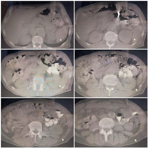 Abdominopelvic CT scan showing post-surgical changes in the abdomen without clear evidence of colocutaneous fistula. The chest findings are unremarkable.
