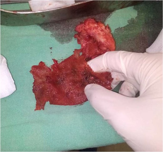Intraoperative findings during exploratory laparotomy revealing a displaced mesh strongly adhered to the lumen of the sigmoid colon. The surgical procedure involved removal of the mesh, resection of 4 cm of the sigmoid colon, and an end-to-end anastomosis.