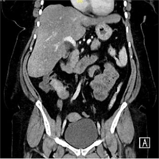Hyper-enhancing spiculated ill-defined lesion at the right lower mesentery measured about 2.9 × 2.2 × 2.4 cm, with no internal calcification or macroscopic component associated with thickening and tethering of the adjacent bowel loops.