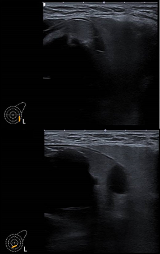 Ultrasound of the left breast showed rupture of the left breast implant with intracapsular and extracapsular leakage, surrounded by echogenic peri-implant fluid.