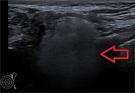 Ultrasound of the left axilla showed the typical appearance of the lymph node siliconoma.